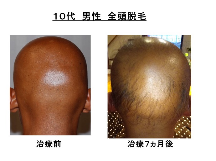 円形脱毛症　病院